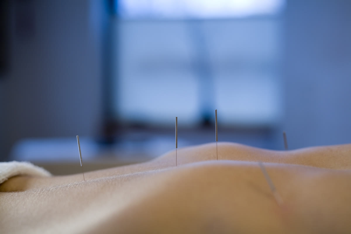 Nahaufnahme: Hände setzen eine feine Akupunkturnadel am oberen Rücken